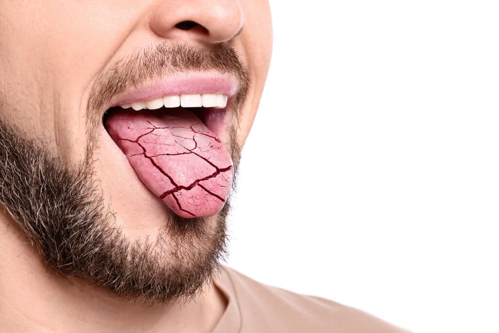 dry mouth