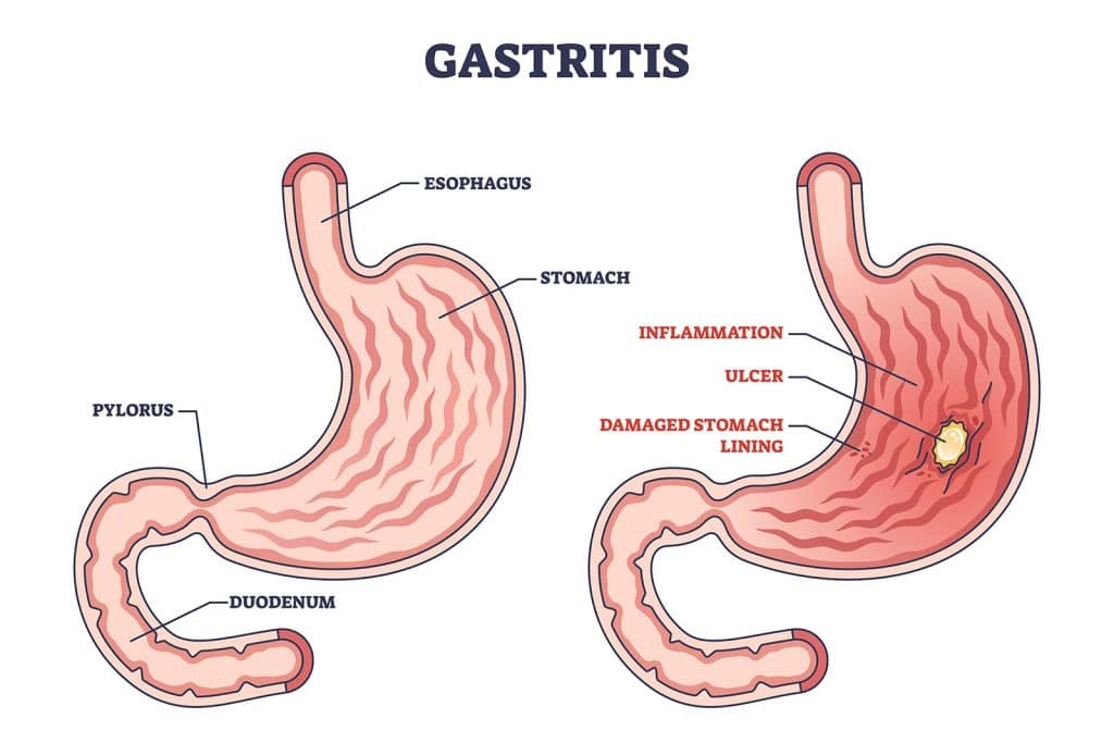Gastritis